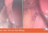 Cảnh báo tình trạng thủng dạ dày ở trẻ em trong thời gian dịch SARS-CoV-2 bùng phát