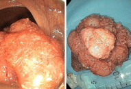 Bệnh viện đa khoa Quốc tế Hải Phòng cắt thành công Polyp trực tràng “khổng lồ” bằng phương pháp cắt tách dưới niêm mạc qua nội soi (ESD)