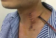 Xử lý thành công vết thương nghiêm trọng vùng cổ do súng bắn đinh