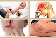 Những biến chứng nguy hiểm của bệnh Sốt xuất huyết
