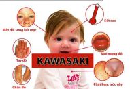 Bệnh Kawasaki và những biến chứng tim mạch nguy hiểm cho trẻ nhỏ